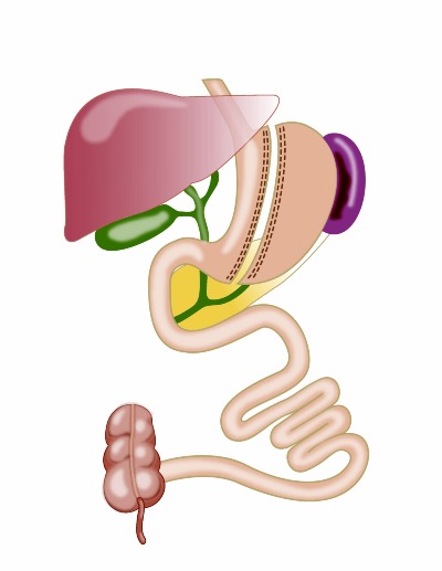 Sleeve gastrectomy is a